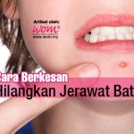 4 Petua Berkesan Hilangkan Jerawat Batu