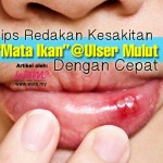 Ketahui Punca Terjadinya Ulser Mulut & Cara Pantas Meredakan Kesakitannya